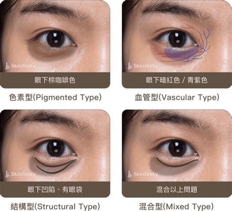 眼睛下黑黑的|你的「黑眼圈」是哪一型？血管型、色素型、結構型.